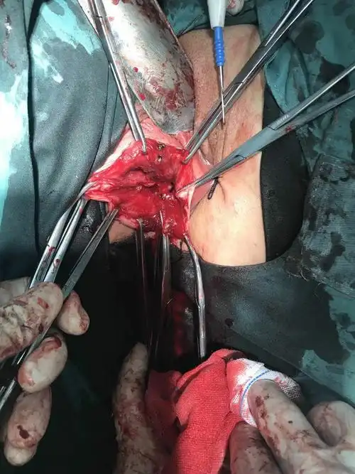 榆林一院病例分享-子宫脱垂行阴式全子宫切除术 阴道残端骶棘韧带悬吊