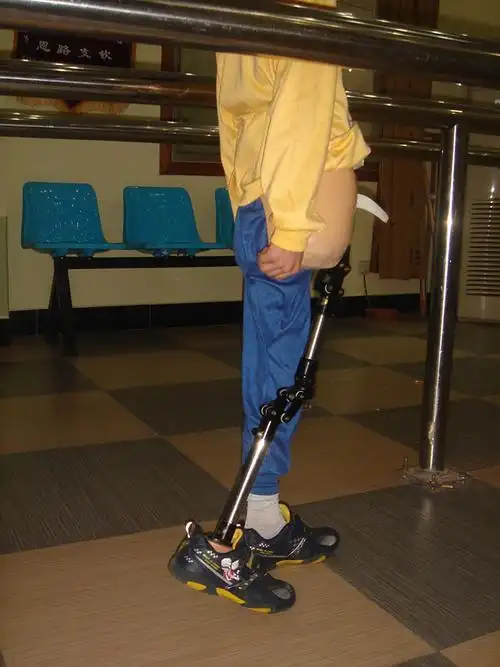 髋离断大腿假肢装配案例