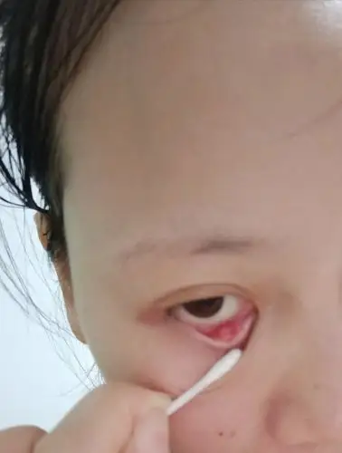 眼睛胀痛,里面有一个白色的小疙瘩,有这样的吗?