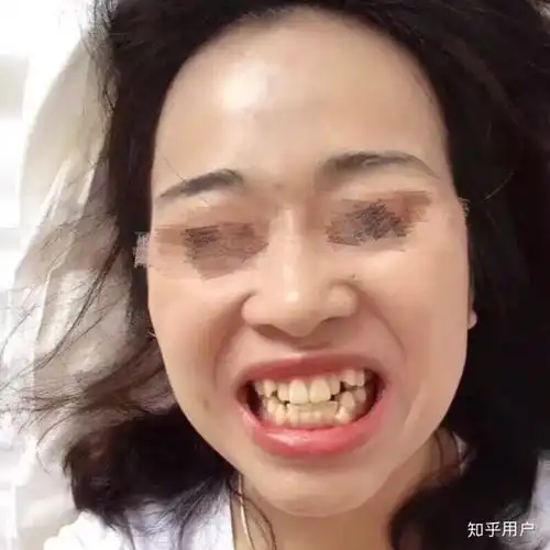 拔牙或者戴牙套正畸,真的可以改变脸型吗?