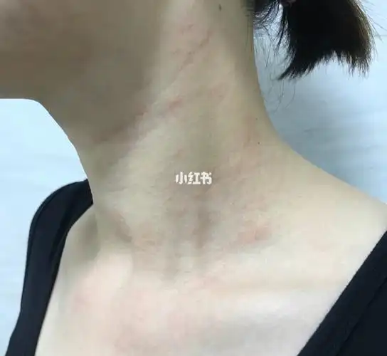 脖子过敏了,红痒长满了小疹子,昨晚用了一片肤元素医用冷敷贴,当晚就