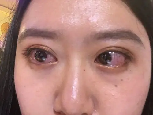 带完美瞳眼睛里面全是红血丝,但是不疼,就是眼睛很酸涩,分泌物很多