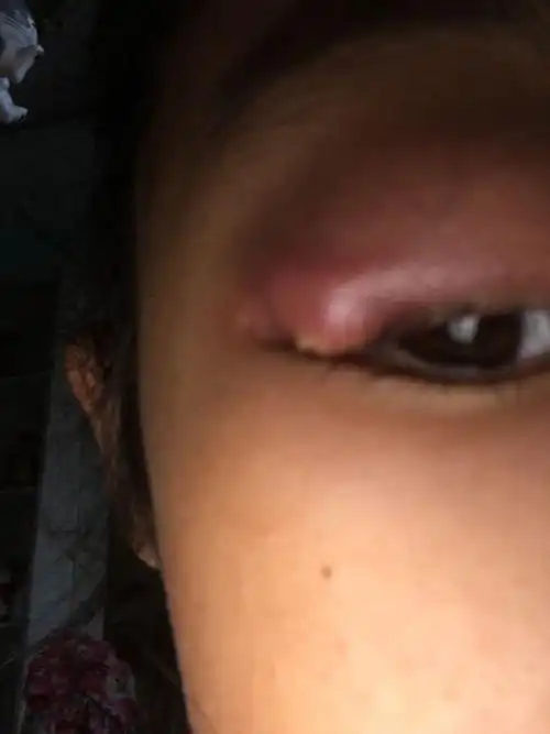 我的眼皮角上长了个小包,他们说是霰粒肿,如果真是霰粒肿,我现在严重