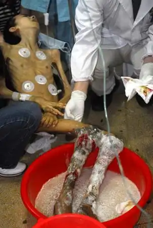 攀攀病情照片心理素质差者请勿看