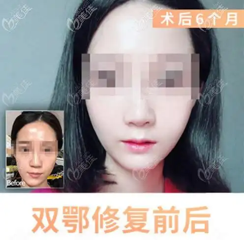 我偏颌长脸做正颌手术变短脸的经历,终于和难看的脸型说拜拜了!
