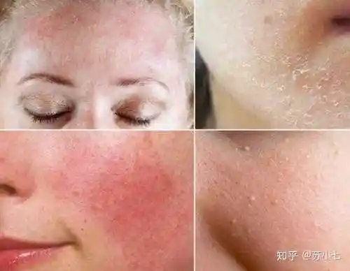 请问我这是皮肤屏障受损?属于什么问题呢?