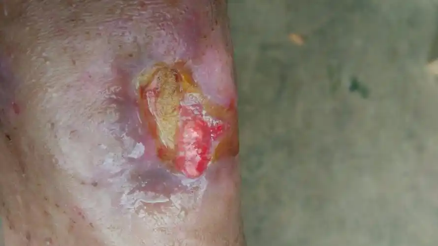 真皮层受损,医生说不用做植皮手术,,可以慢慢恢复,,可是一个多月了