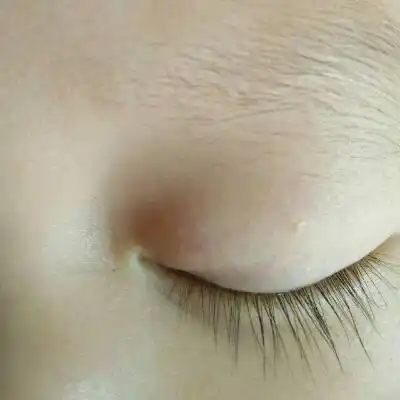 我家宝宝不到两周,上眼皮内部有个小包,睁开眼睛看不见,闭着眼很明显