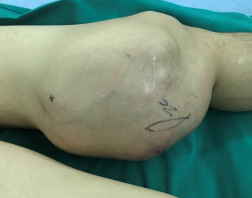 30岁男子左腿长了篮球大小的肉瘤只能截肢