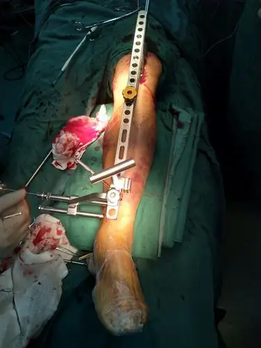 半伸直位胫骨髓内钉(2)