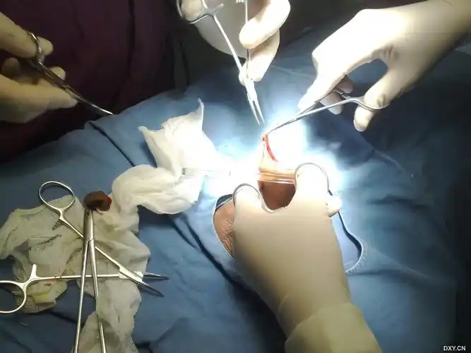 【进展】包皮套扎全过程高清图片