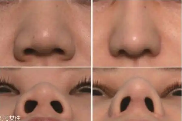 鼻翼缩小手术前后对比照片缩鼻孔手术对比照片