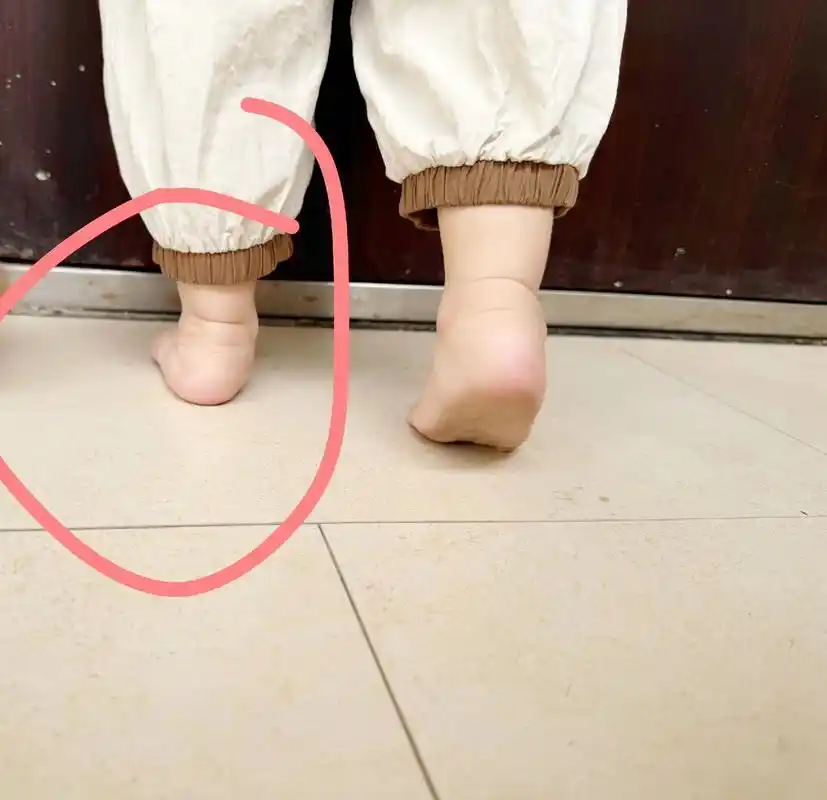 足外翻,小腿外翻