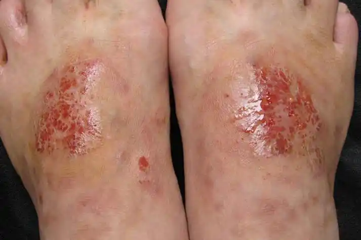 揭秘!湿疹图片初期症状图"高效安全"-第1张图片-浦西博客