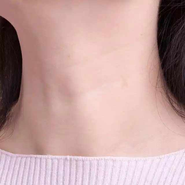 女人脖子冒出"三道杠",知道代表什么吗?建议:赶快重视起来!