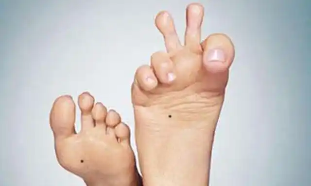 左脚第三四根脚趾头骨折 约四十天去掉了石膏