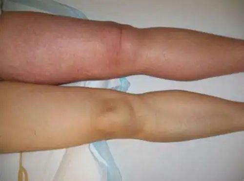 浮肿图 (28)_有来医生