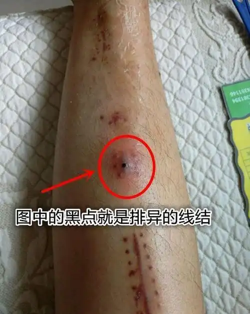 其实各个部位的手术切口都可能出现排异反应,比如下图是个骨外科的