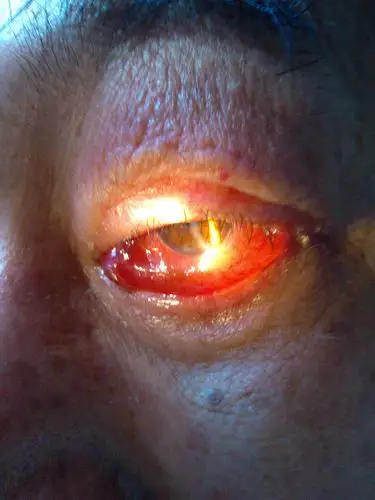 上睑下垂矫正术后,结膜水肿.