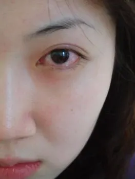 结膜炎的症状是什么