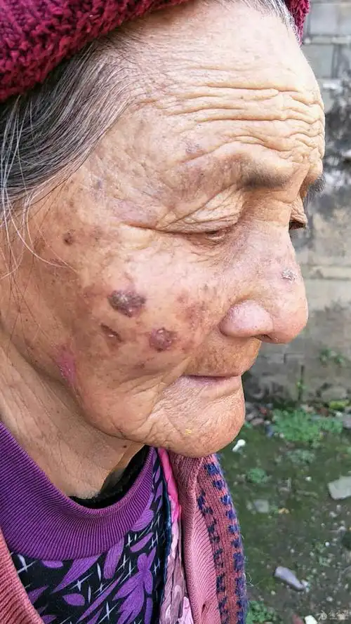 皮肤疾病猜图积分大派送306日光性角化