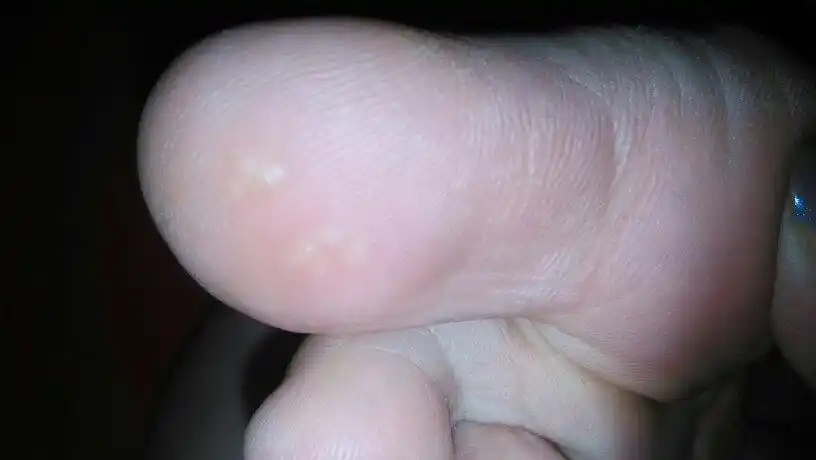 大母脚趾头下长了几个透明的包,很硬,不痛不痒的,之前没有这么大,感觉