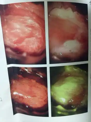 请问我宫颈糜烂严重么