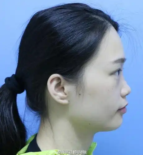 一个关于消灭塌鼻梁的故事