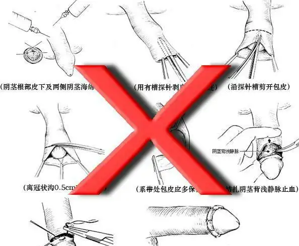 包皮过长,往这看(⊙o⊙)!