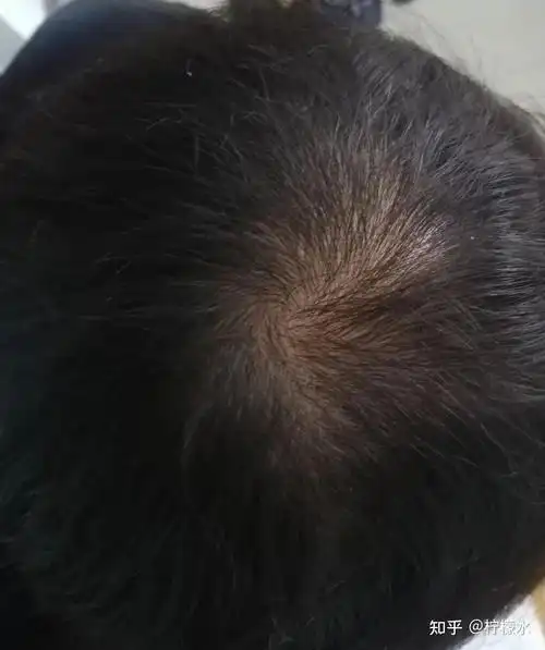 男生脱发怎么办摆脱油头减少掉发