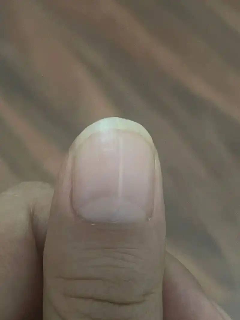 指甲突然有白色竖条纹 指甲上长白竖纹是什么原因啊