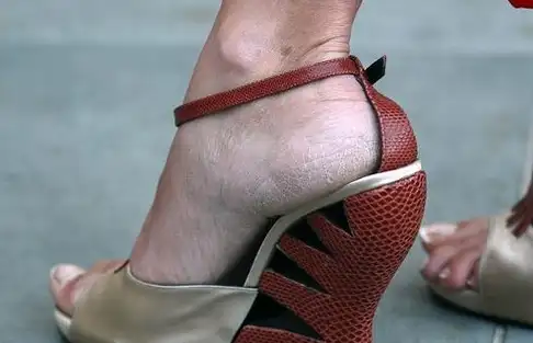 为何有的人脚后跟喜欢"干裂"?若你也有,不妨来了解一下原因吧