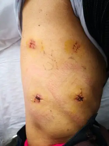 阳泉市第一人民医院开展胸腹腔镜联合食管癌根治术