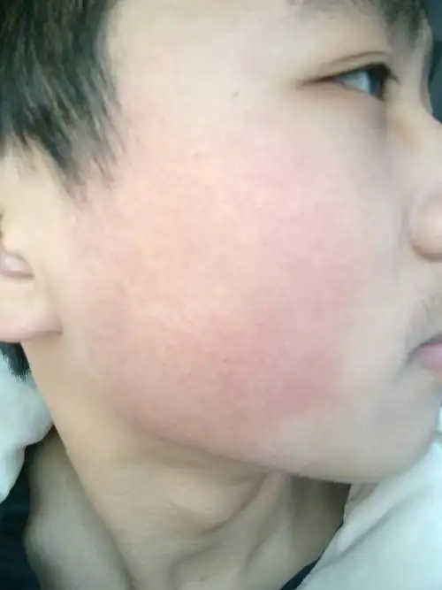 脸一直这么红怎么办?