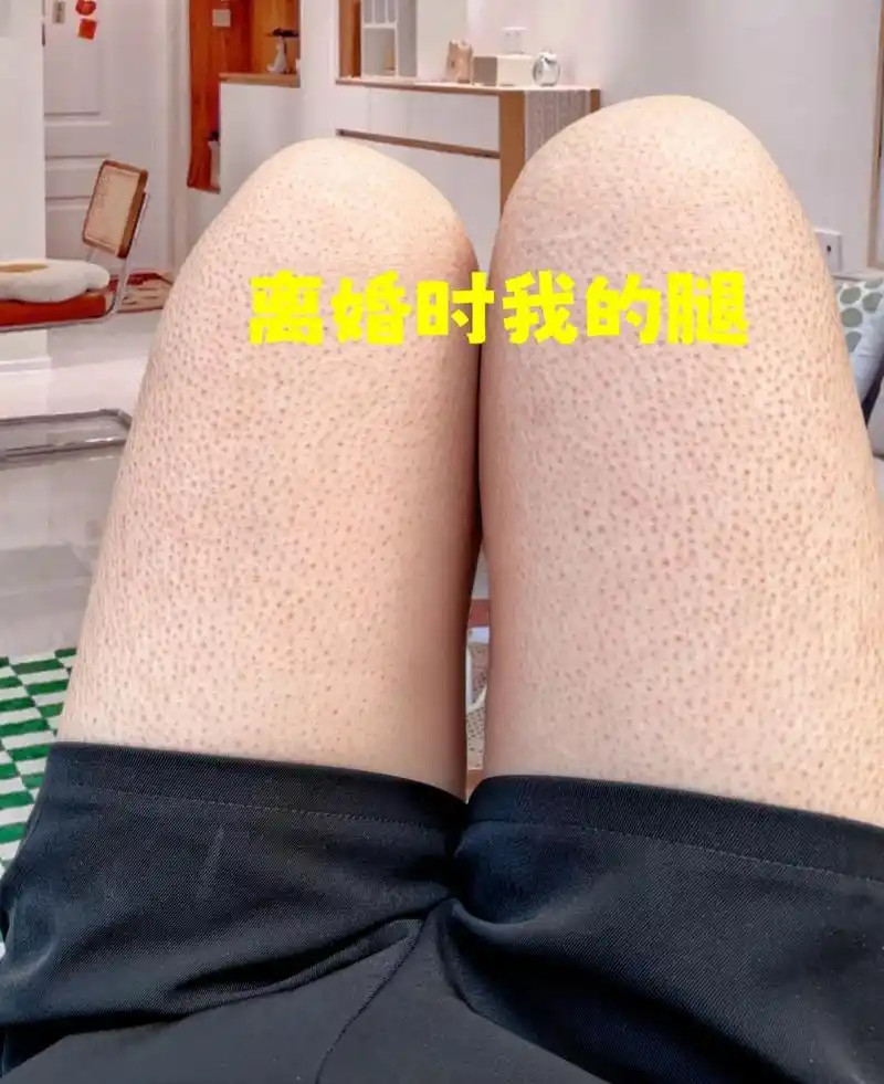 鸡皮肤 多亏了舞蹈生闺蜜告诉我的#尿素霜去鸡皮 小办法,没 - 抖音