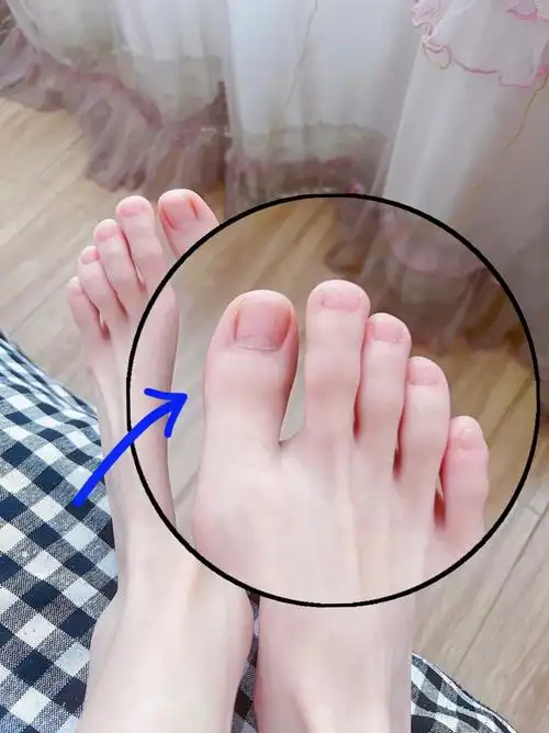 因为脚上灰指甲跑去了皮肤科了