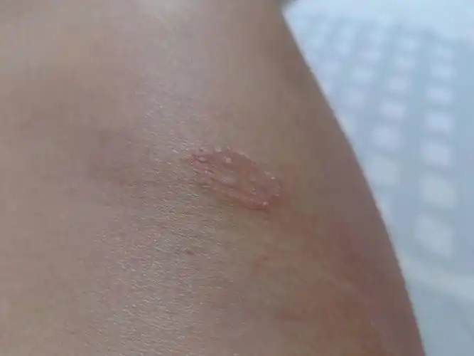 身上起了个癣,不知什么病?也不疼也不痒,请高手鉴定一下.