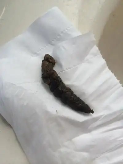 胃癌黑大便图片 (40)