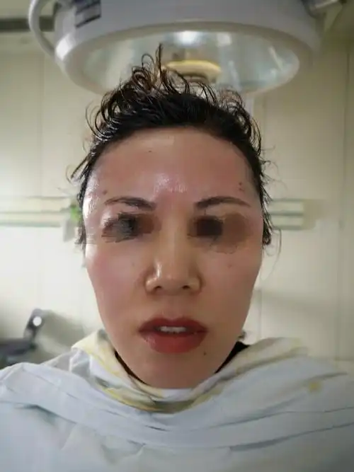 自体脂肪填充的颞部,额部 - 好大夫在线