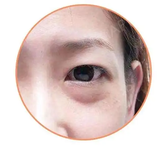 下眼袋肿怎么消除(下眼袋肿如何消除)