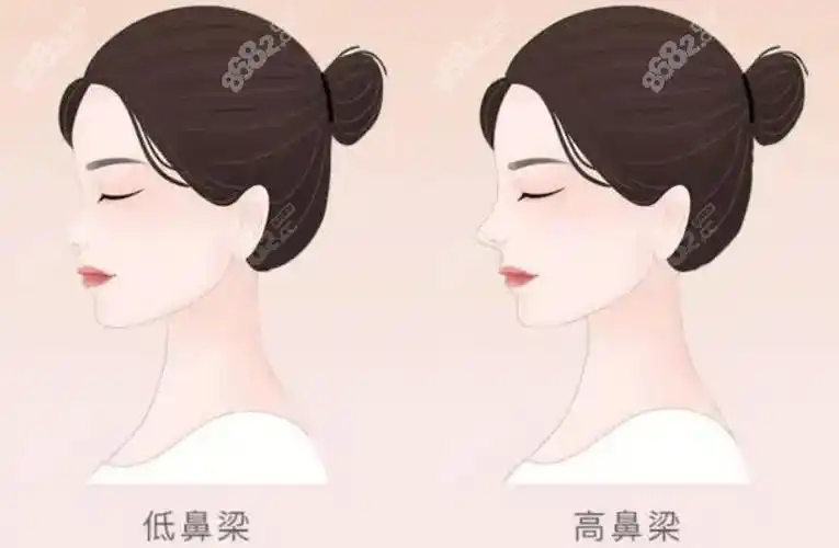 韩国高难度鼻修复找哪位好,鼻部对比照-8682赴韩整形网