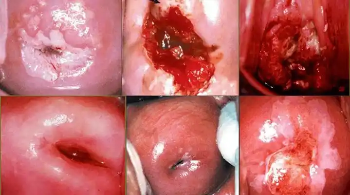 宫颈癌图片 (32)