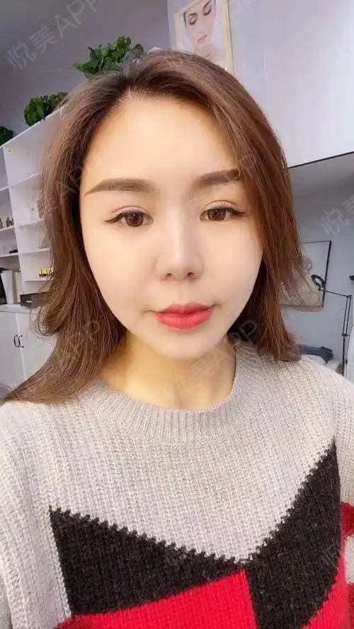 自体脂肪面部填充术后15天_面部填充术后15天_自体脂肪术后15天_情绪