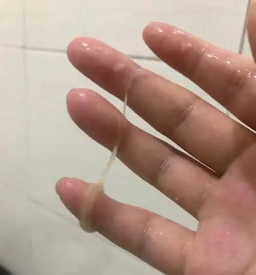 霉菌阴炎症状 (2)_有来医生