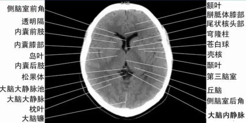 颅脑ct怎么看正常和异常影像分别是什么