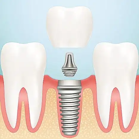 种植牙的过程!_南京康贝佳口腔医院_市医保定点