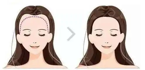 正常m型发际线是怎么样的