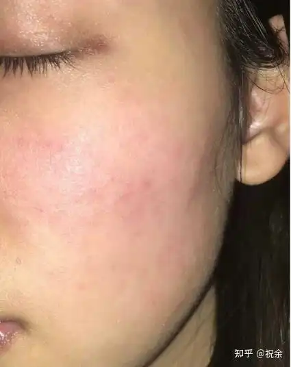 5年的红血丝患者不请自来!