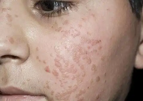 扁平疣图片和症状图片