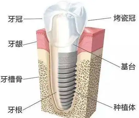 种植牙一般需要种多久种牙的原理是什么老人种牙有什么影响